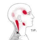 승모근(Trapezius Muscle)의 근막통증후군 이미지