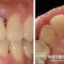 바른이치과기공소 네이버블로그