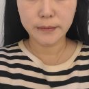 메디컬오한의원 | 수원 메디컬오 한의원 리프팅 13회차 후기, 유지관리 만족 중