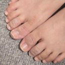 김지수한의원 | 부산한포진한의원? 약 6개월의 치료과정을 공개합니다. <출처 : 대학병원 학회지>