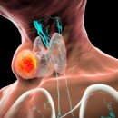 발병률 1위 갑상선 암, ‘착한’암 맞나? 이미지
