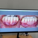 하임메디 | 잇몸이식 D-day ~ 14일차 후기