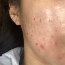 철 민감성 케어 수분진정 밤부 수분크림/진정세럼 추천(베르가모 내돈내산 후기),건대 톤즈의원 리쥬란 2cc