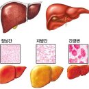 지방간 원인과 치료법 이미지