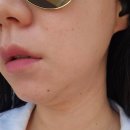 문정역 피부과 온다리프팅 잘하는 곳! 여름준비 이중턱관리 후기