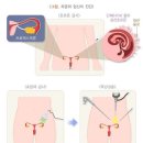 자궁각 임신의 손해보상 여부[O00.8기타 자궁외 임신] 이미지