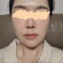 명동프라자 | 남대문피부과 명동 티타늄 리프팅 후기