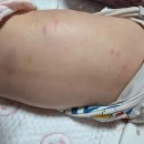 울산아이가정의학과의원 | 땀띠vs두드러기 차이 / 여름에 생기는 좁쌀땀띠/두드레기