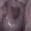 신호 | 자궁경부 원추절제술 후기로 보는 재발 신호