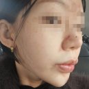 강남대로3-8 | 강남 쥬브아셀 8% 통증과 효과 리브힙의원 역대급 후기