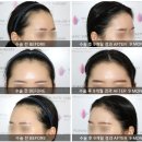 유앤미여성외과의원 | 40대 여성 잔머리 살리며 울퉁불퉁한 헤어라인 + 정수리 가르마 개선