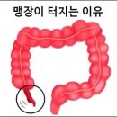 맹장이 터지는 이유 맹장 터지면 나타나는 증상 이미지
