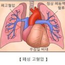 폐동맥 고혈압 과 원인, 와, 합병증까지 총정리 이미지