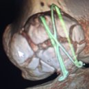 바로병원 | 대구 교통사고 무릎 슬개골 골절 수술-바로본병원 입원 및 수술후기