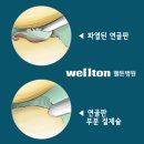 십자인대파열,관절내시경, 십자인대수술, 무릎수술 ＞＞ 웰튼병원 이미지