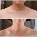 건강 셀프마사지 | 목요일은 올리고데이 &#39;승모근관리&#39; 2탄 셀프마사지 후기