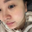 미라젯 리쥬베룩 유니크리쥬란 무통 리쥬란 쥬베룩 같이 받은 후기(통증, 효과, 가격)