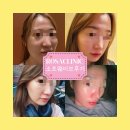 로사의원 | 로사 클리닉 소프 웨이브 100샷 후기 (유지어터 인증)