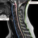 무주신경외과 | 대구목도수, 후종인대골화증 꼭 수술해야하나요? [서부통신경외과] 대명동, 송현동, 서부정류장, 상인동