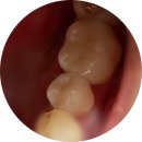 방경환동행치과의원 | 방경환동행치과 충치 치료 후기[부산 동래 치과, 부산 양심 치과, 과잉진료 없는 치과]