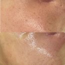 씨유 천안용곡우림필유점 | 천안 모공 관리 브이라인 트라이엄레이저 남자 피부관리 후기