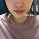 30살 기념 화곡동 치과 까치산 연세플라워치과 까치산 사랑니 발치 후기 (출혈,멍,붓기)