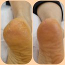 레푸스풋풋한리쌤 | 동탄 발각질 관리 재방문! 풋풋한리쌤 동탄역점에서 깨끗하게