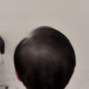 꽉찬두피