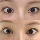 솔디자인 - 남동구 은청로 4-7 | 압구정피부과 수입 눈밑필러 잘하는 곳 다녀온 솔 후기