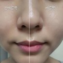 출산 후 기미 때문에 써본 베스티안 SP MD 크림 사용후기