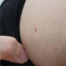 하늘뿌리한의원 | 언주역한의원 비에이한의원 몸통 편평사마귀 제거 내돈내산 생생후기(+한달 후기)