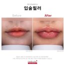 입술필러 총정리(주기,멍,효과,입꼬리필러 등)