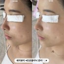운남약국 | 수완지구 모공클리닉 <세이뷰티> 요철피부 탈출후기✌🏻