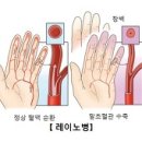 레이노병을 당귀사역가오수유생강탕으로 치료함. 이미지