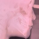 압구정민치과의원 | [내돈내산] 5세(52개월) 프랑켈 치아 교정 시작기(압구정민치과)