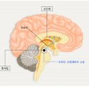 파킨슨병 초기 파킨슨병 말기 원인 이미지