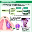 끈적끈적한 콧물이…치료가 어려운 호산구성부비강염。 코 용종 절제와 스테로이드로 증상컨트롤 이미지