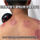 참좋은의료기기 | 가정용부항 온열부항의료기기 온부기 사용후기