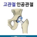 대퇴골두무혈성괴사/고관절/고관절수술/고관절인공관절 이미지