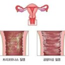 질 및 외음부의 기타 염증[other inflammation of vagina and vulva] 이미지