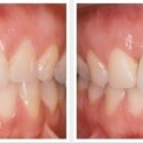 수플란트 이미지