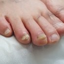 주손척척의원 | 주손척척의원에서 문제성발톱 발톱무좀 고민 해결해보세요!!