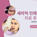세라믹치과의원 | 치과 세라믹 인레이 치료 후기, 이 시림