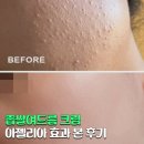 좁쌀여드름 크림 아젤리아 효과 본 후기