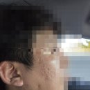 광주한의원 | 광주 흉터치료후기 광천동 흉터전문한의원