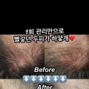 1회 관리만으로빨갛던 두피가 하얗게!? #두피관리 #헤드스파 #다와맨즈토탈뷰티 이미지