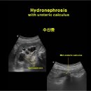 Hydronephrosis with mid ureteric calculus 이미지