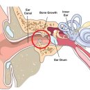 덴마크보청기 이미지