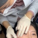 이마 | 서울편평사마귀비립종 명동 눈가 이마 제거 내돈내산 후기