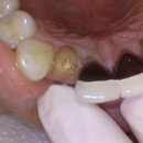 미소준치과의원 | 앞니가 갑자기 부러졌다고요…? 임플란트 대신 살려준 오리역 ‘리볼리치과의원’ 후기